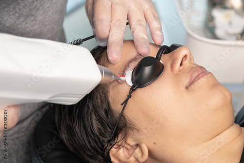 Laser application to remove a tattoo on a woman's eyebrow.