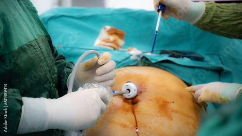 Obesity surgery. Weight loss surgery with laparoscopy technique.