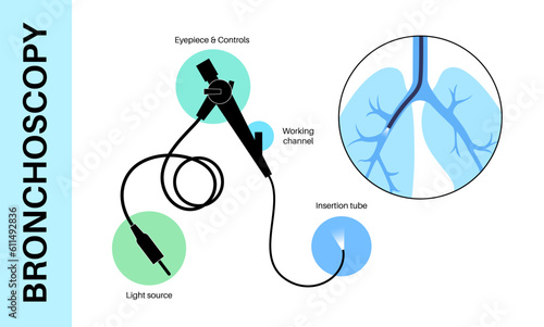 Bronchoscopy procedure concept