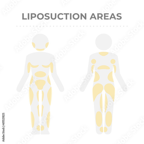 Target areas for liposuction treatment.
Vector infographic medical pictogram of the human body with fat deposit marks.
Graphic scheme of localized fat mass tissue in front and back body parts