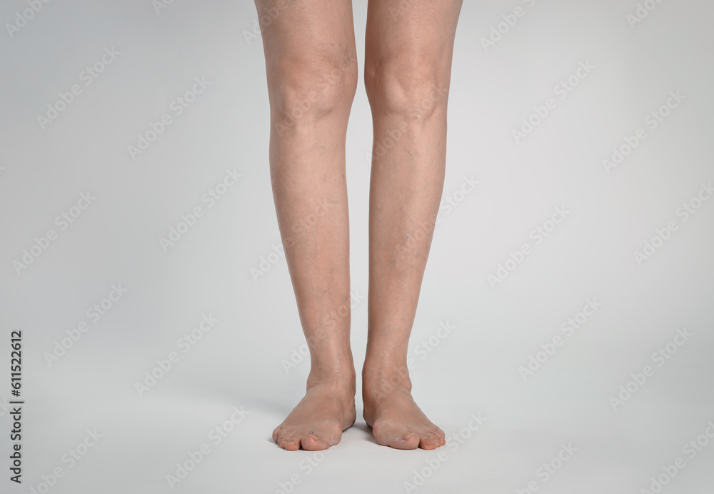 Closeup view of woman with varicose veins on light background Closeup view of woman with varicose veins on light background
