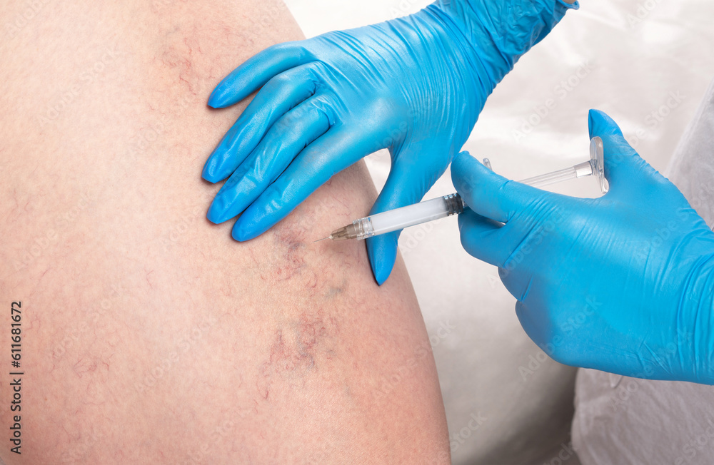 doctor shows the dilation of small blood vessels of the skin on the leg. Medical inspection and treatment of Telangiectasia. sclerotherapy procedure doctor shows the dilation of small blood vessels of the skin on the leg. Medical inspection and treatment of Telangiectasia. sclerotherapy procedure