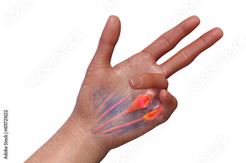A 3D medical illustration displaying a patient's hand with Dupuytren's contracture, emphasizing the affected tendons and palmar fascia