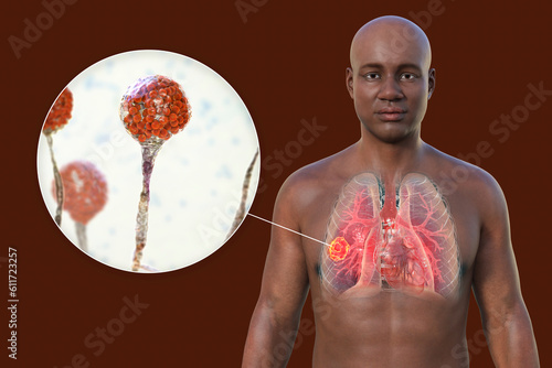 A 3D illustration of the upper half part of an African man with transparent skin, revealing a lung mucormycosis lesion, with close-up view of Mucor fungi photo