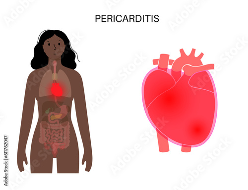 Pericarditis heart disease
