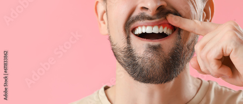 Man with gum inflammation on pink background, closeup