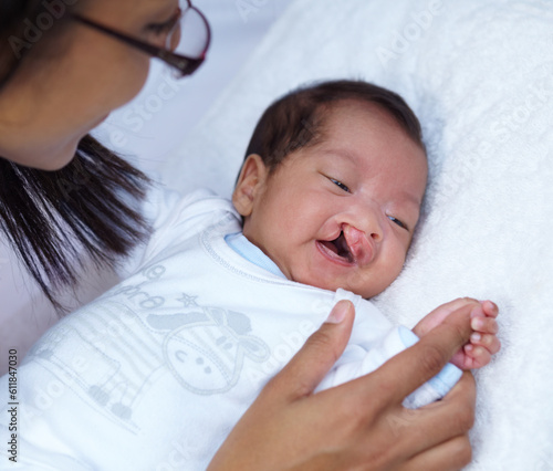 Fotografía Newborn, cleft palate and parent care for a baby happy in a home bed with a smile in a bedroom or medical centre