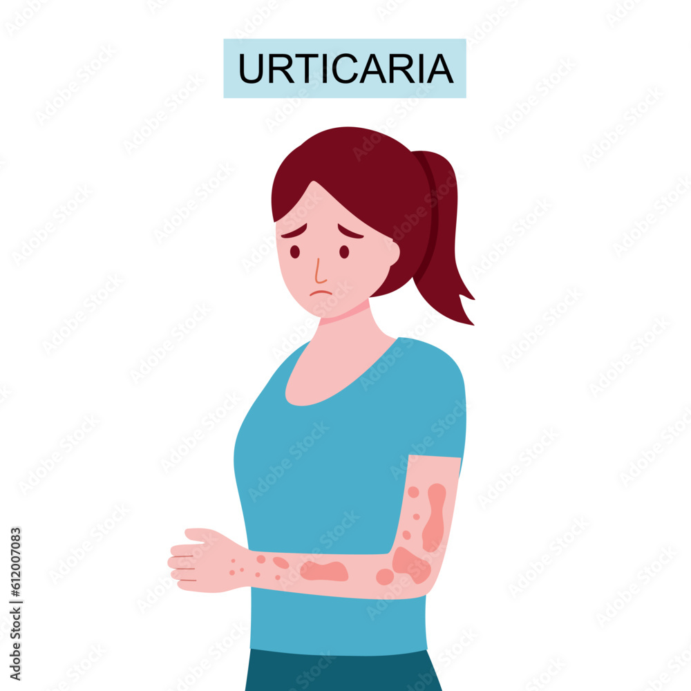 Woman with urticaria skin disease in flat design on white background. Woman with urticaria skin disease in flat design on white background.