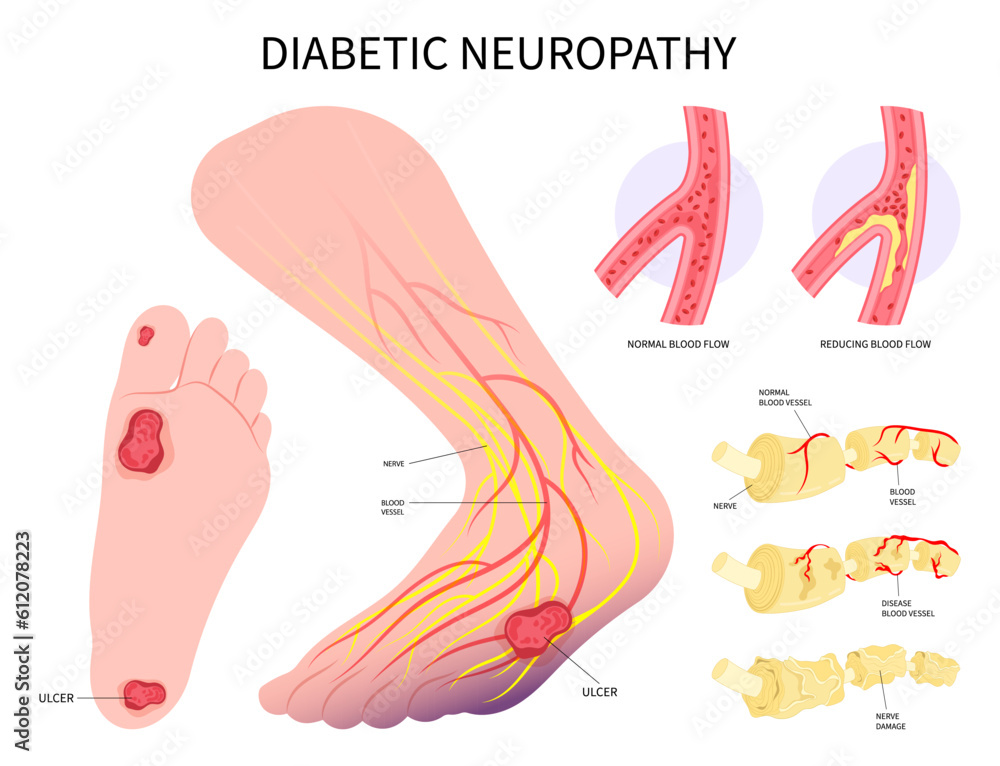 Diabetic feet limb nerve clot damage of Charcot conduction velocity screening in leg bacteria sensory gout glucose plaque fat high sugar blister tingling test callus corn stroke pain injury Diabetic feet limb nerve clot damage of Charcot conduction velocity screening in leg bacteria sensory gout glucose plaque fat high sugar blister tingling test callus corn stroke pain injury
