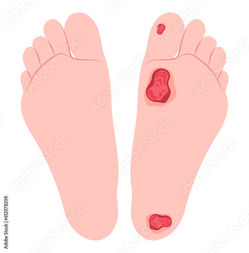 Charcot conduction velocity screening in leg feet limb pain injury nerve clot damage of bacteria sensory gout glucose plaque fat high sugar blister tingling test callus corn stroke Diabetic