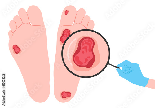 feet limb pain injury nerve clot damage of Charcot conduction velocity screening in leg bacteria sensory gout glucose plaque fat high sugar blister tingling test callus corn stroke Diabetic