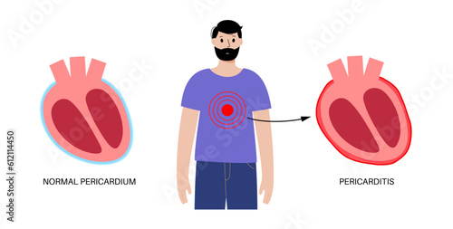 Pericarditis heart disease