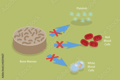 3D Isometric Flat Vector Conceptual Illustration of Aplastic Anemia, Blood Disorder Causing Low Blood Cell Production
