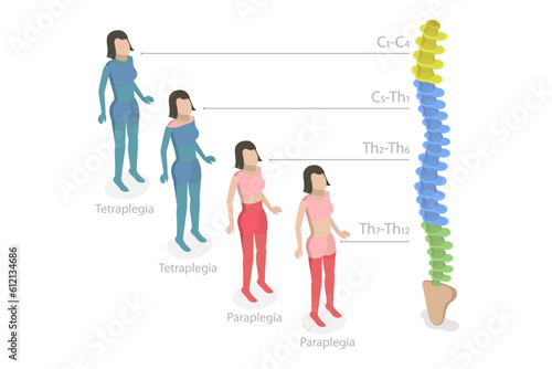 3D Isometric Flat Vector Conceptual Illustration of Tetraplegia And Paraplegia , Neural Medical Disorder
