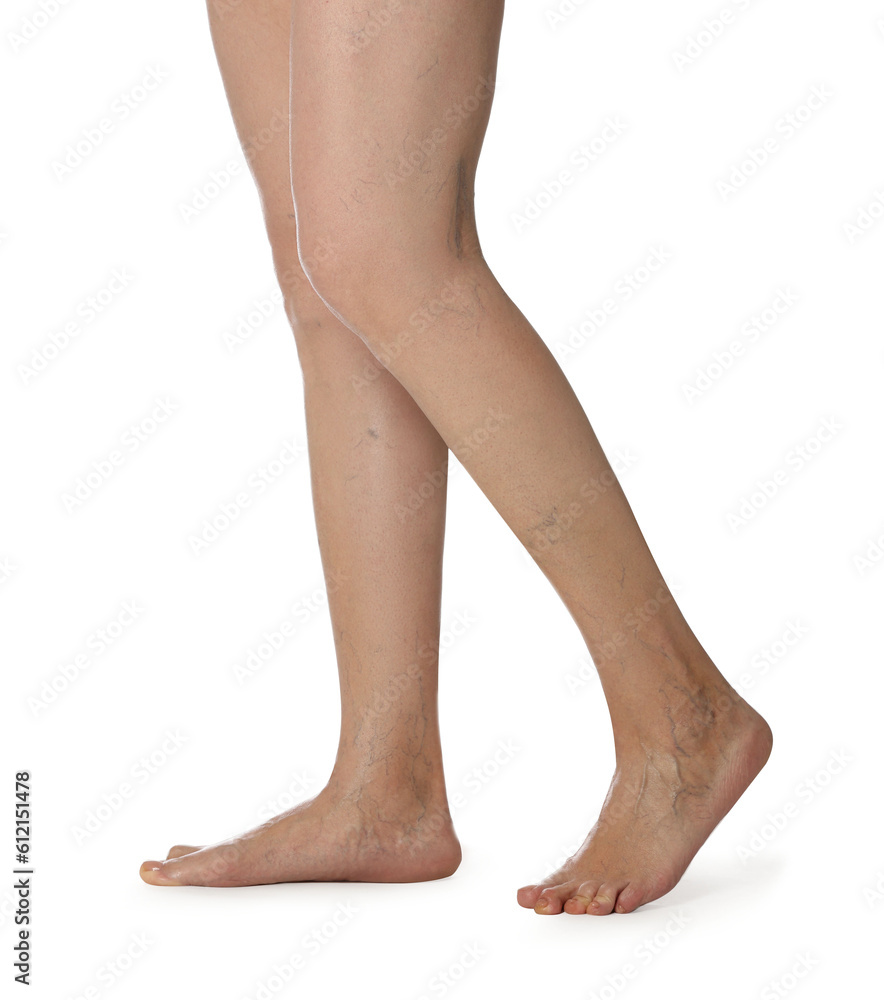 Closeup view of woman with varicose veins on white background Closeup view of woman with varicose veins on white background