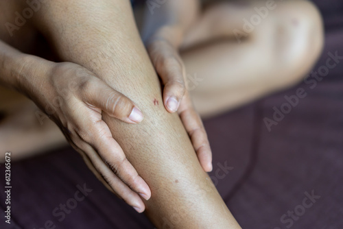 Woman having scar and scraped knee.