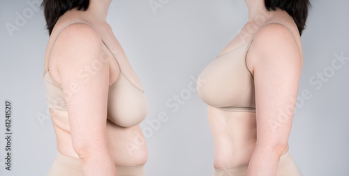 Before and after breast augmentation concept, woman with very large silicone breasts after correction surgery photo