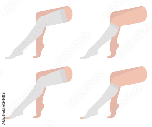 Set of compression stockings, knee-high, socks, open toe. White color. Female legs sitting with varicose veins. Blood pressure, swelling. Medical underwear for feet. Specialized hosiery for diseases.