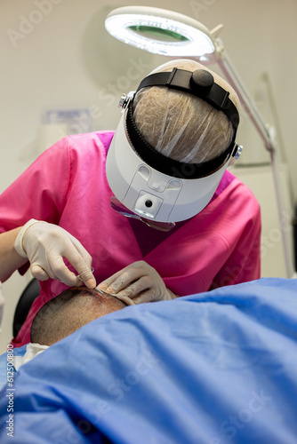 Hair transplantation. Baldness treatment.Alopecia