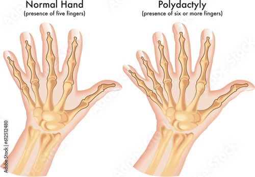 Medical illustration of a hand afflicted with Polydactyly, a congenital abnormality characterized by the presence of six or more fingers.