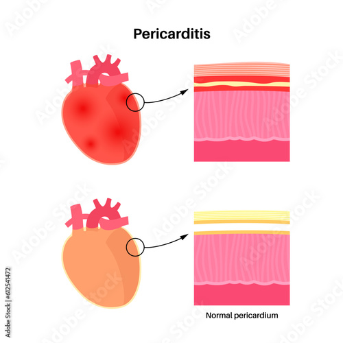 Pericarditis heart disease