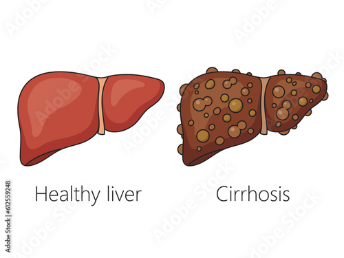 Healthy liver and liver with cirrhosis disease schematic vector illustration. Medical science educational illustration