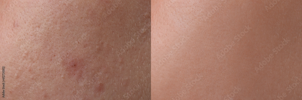 Fototapeta premium Collage with photos of person suffering from acne before and after treatment, closeup. Banner design showing affected and healthy skin