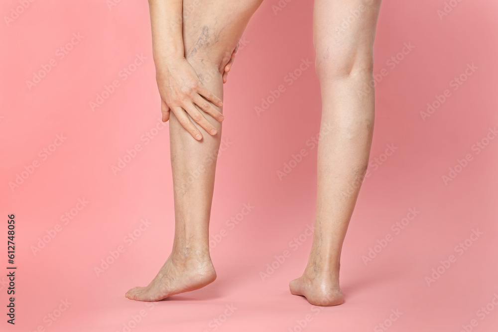 Closeup view of woman suffering from varicose veins on pink background Closeup view of woman suffering from varicose veins on pink background