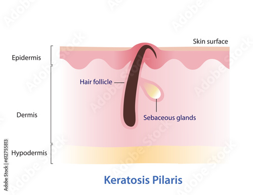 Keratosis Pilaris. Ingrown hair, Chicken skin vector illustration isolated on white background. Hair has grown back into the skin surface. Bumpy skin that looks like tiny pinpricks or goosebumps.