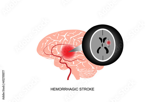 Illustration of cerebral hemorrhagic stroke and brain imaging.