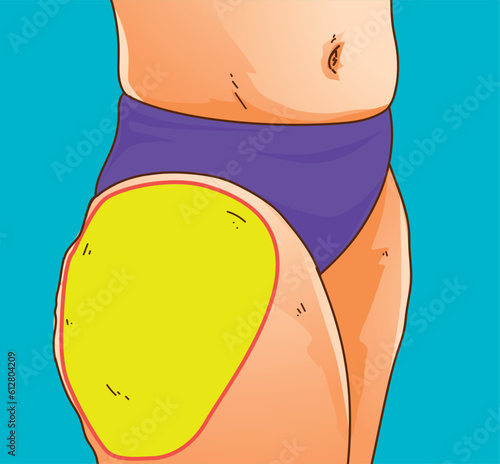 A woman's body with belly fat. Problem zone. Medical infographic. Healthcare illustration. Vector illustration. 