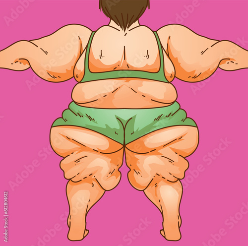 Lipedema. Women's body with health problems. Healthcare illustration, medical infographics. Vector illustration.
