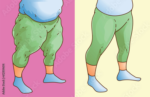 Lipedema. Women's legs with health problems. Before, after. Healthcare illustration, medical infographics. Vector illustration.