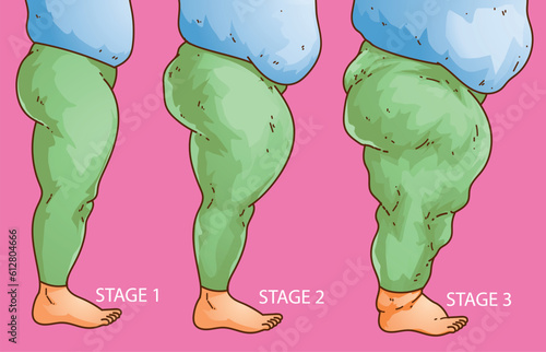 Stages of the lipedema. Women's legs with health problems. Healthcare illustration, medical infographics. Vector illustration.