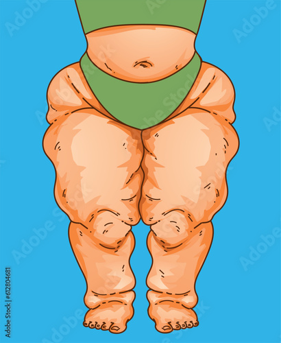 Lipedema. Women's legs with health problems. Healthcare illustration, medical infographics. Vector illustration.