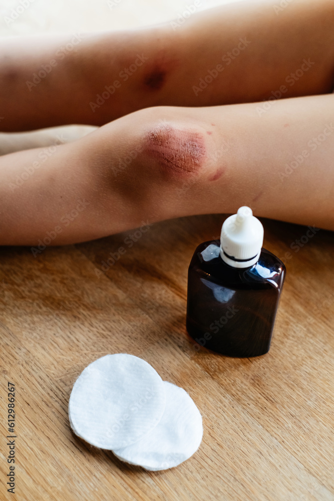 Children injury. Deep scratches on the skin on the kids knee. Wounds ...