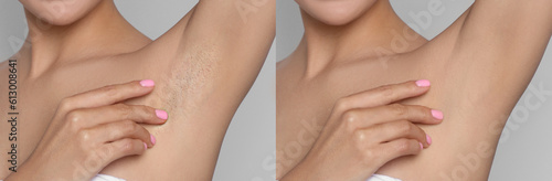 Before and after epilation. Collage with photos of woman showing armpit on light background, closeup photo