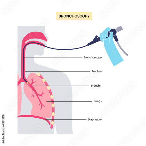 Bronchoscopy procedure concept