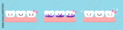 White cute tooth and with yellow tartar before after plaque test icon set. Kawaii teeth in gum stain treatment, remove and cleaning, whitening concept. Kids dental plaque identification at home.