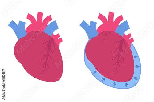Pericardial effusion concept. Cardiovascular system medical vector illustration. photo