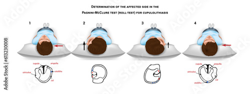 Pagnini McClure roll test for cupulolithiasis vector