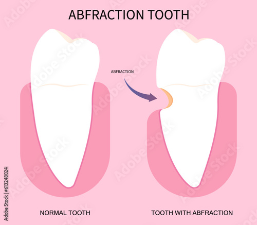Abfraction disease of teeth fracture crack broken and grinding pain toothache syndrome Bad breath in dentistry