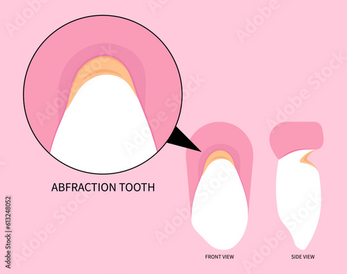 Toothache in dentistry with abfraction disease of teeth fracture crack broken and Bad breath grinding pain syndrome	