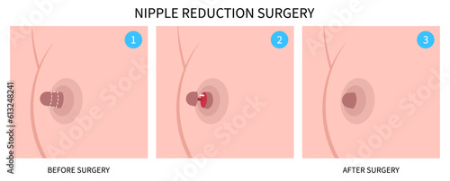 Nipple Reduction and Areola Surgery the gynecomastia lift Breast cosmetic augmentation correction implant sticking out protrude reduces asymmetric of areolae enlarged photo