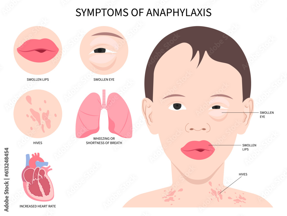 Anaphylaxis allergy Face swollen and bee sting the Epinephrine drug