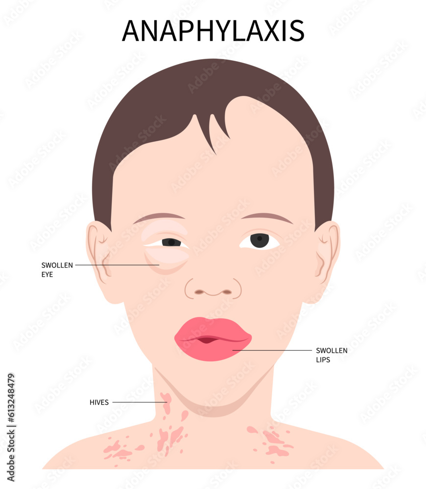 Face swollen and bee sting the Epinephrine Anaphylaxis allergy drug dose adrenaline of allergen nut syringe treat life threatening in septic heart failure Face swollen and bee sting the Epinephrine Anaphylaxis allergy drug dose adrenaline of allergen nut syringe treat life threatening in septic heart failure