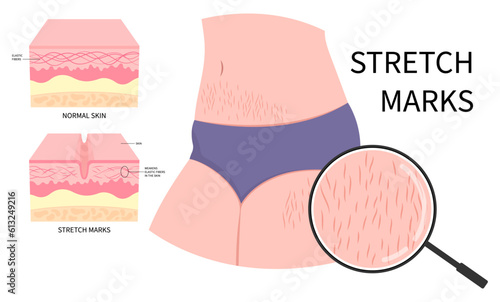 Body cellulite of overweight leg women female and stretch marks or gain loss muscle the stomach chemical peel in Laser therapy loose with Cushing's steroid removal