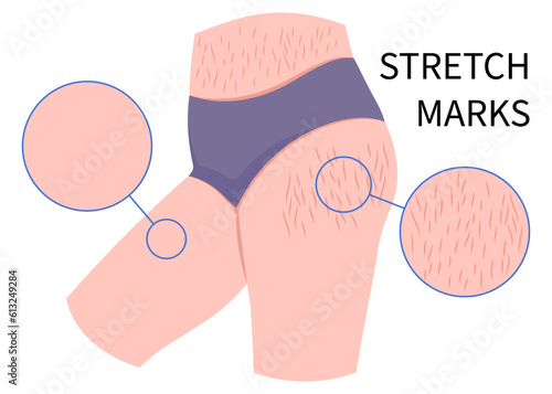 chemical peel Leg women female with cellulite removal for Cushing's overweight steroid in stretch marks and gain loss muscle the loose body stomach by Laser therapy