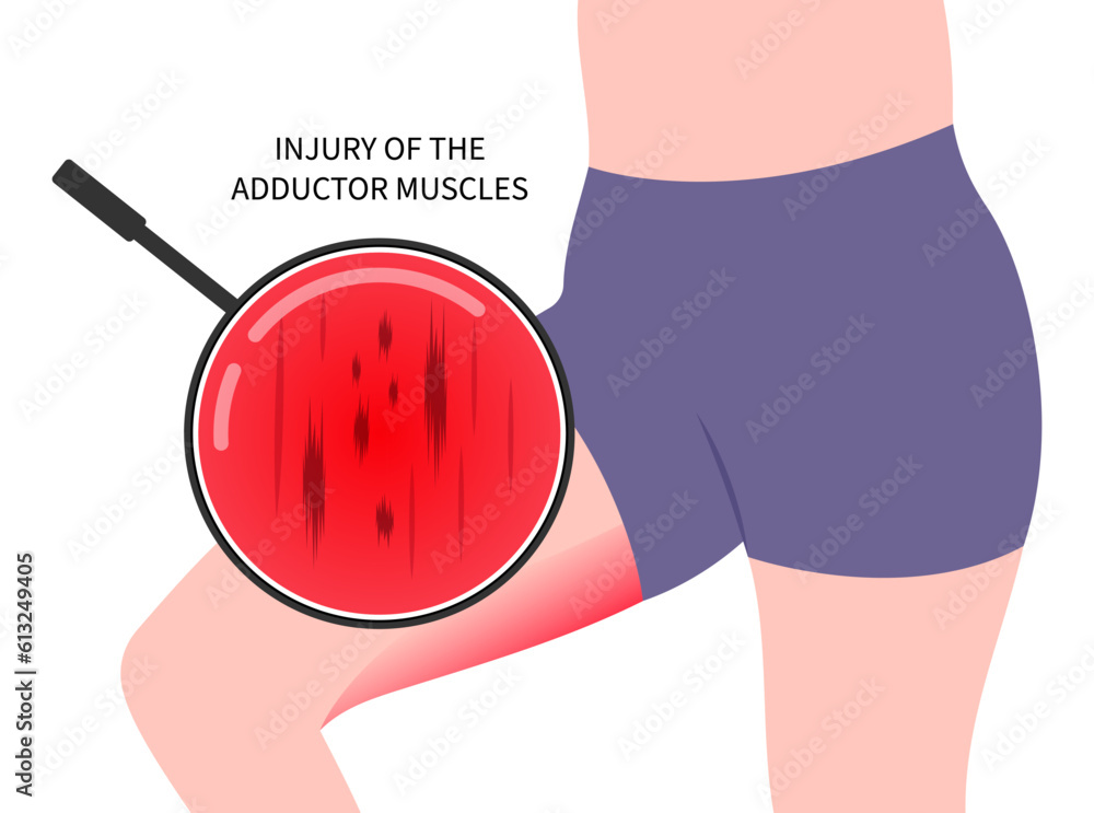 Vetor de Bursitis fracture in plexus flexion muscle with groin strain