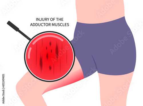 Bursitis fracture in plexus flexion muscle with groin strain thigh pain injury or hip lumbar rotation back and Obturator nerve externus lower the first aid of RICE Rest Ice stress